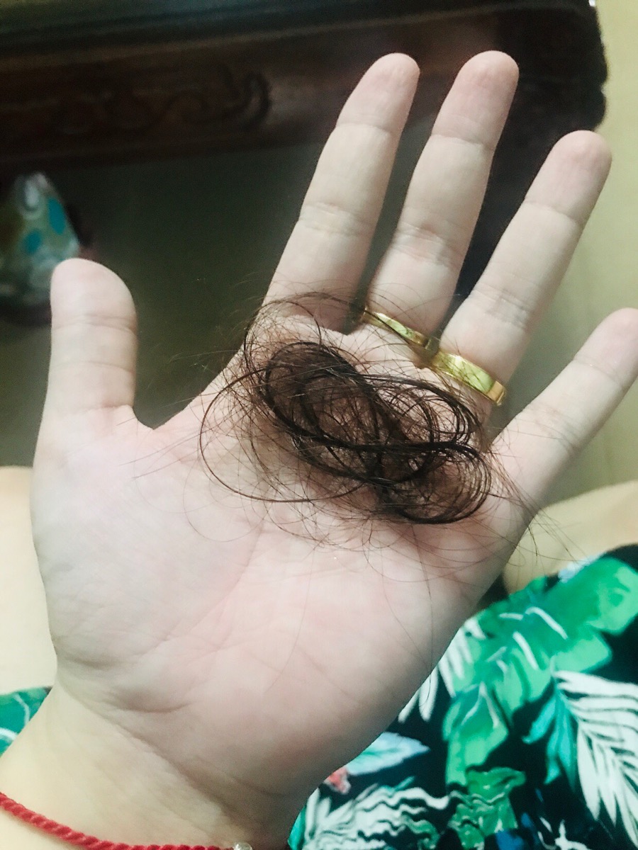 Có ai bị như em k ạ. Bầu 18w tóc rụng hết rồi... stress thực sự... không biết phải làm thế nào nữa các m ạ ☹️☹️☹️ Có ai bị như em mà tóc k rụng nữa k ạ
