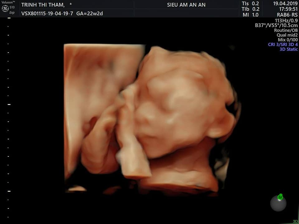 Sau khi Mẹ tròn - Con vuông - Bố chữ nhật mình xin revew công cuộc đi đẻ của mình tại BVBĐ để các m cb đẻ và đang tính đẻ tại BVBĐ có thêm thông tin. ( chuyện mình kể hơi lủng củng các mẹ nhé)
Mình mang bầu tập 1 bị sảy ở tuần thứ 6. Sau đó 3 tháng mình có bầu lại. Mình theo dõi khám ở PK An An. 3 tháng đầu mình phải sử dụng thuốc nội tiết để giúp thai phát triển tốt. Dks của mình là 21/8 ( theo kinh 3 tháng đầu). Nghề nghiệp của mình là điều dưỡng nên cứ hàng tuần nào mình cũng siêu âm tại cơ quan. Và các mốc quan trọng thì kiểm tra tại An An. 26w mình bị tiểu đường thai phải nhập viện bạch mai điều trị theo dõi 3 ngày. Sau ra viện thì chỉ điều chỉnh ăn uống và kiểm tra test đường tại nhà. 28w mình có cơn gò nhiều. Bs Nam _ S/â An An kê cho mình thuốc giảm gò uống đến 35w. Mình luôn sợ sẽ sinh non, chỉ cầu trời khấn phật sao cho con an toàn trong bụng qua 36w là mừng lắm rồi ( vì lúc 32w mình chuyển về nhà mới. Nên lại càng sợ k may mắn cho con). Nhưng đến 39w vẫn thấy mọi thứ bình thường. Rồi qua rằm tháng 7 vẫn chưa thấy gì. 40w 21/8 mình qua An An siêu âm ktra. Ối còn 104mm. Lại lo lắng con bị cạn ối sẽ nguy hiểm. Bs Nam nói tối 22/8 chưa thấy gì thì nhắn cho bác để bs nhờ bs trực phòng đẻ giúp cho 23/8 nhập viện kích đẻ. Tối 21/8 vk ck vẫn dắt tay nhau đi bộ 30p Rồi đi ngủ, đến 1h sáng 22/8 thì mình thấy đau bụng, bụng gò cứng nhưng mình cũng là k gọi ck dậy mà chỉ nằm nghe ngóng. Thấy cứ cách 1 h lại có 1 cơn đau. Sau đó 45p. Rồi 30p. Cứ thế đến 5h30p. Mình gọi ck dậy thắp hương, tắm gội ( lúc này mình mới thấy ra máu và bong nút nhầy) 2 vk ck chạy xe máy vào viện, đi đường cứ 10p mình lại đau 1 cơn kéo dài khoảng 30s.đến bv Lên thẳng tầng 3 lúc ấy là 6h30phút. Ck chạy xuống tầng 1 làm thủ tục đăng ký khám rồi đưa mình vào phòng 302 khám. Có bs nam giới đeo kính đen khám trong cho mình. Xong khi mình ra ngoài thì thấy bảo CTC mở 7 cm. Và giấy khám của mình đc tích cấp cứu. Sau khi làm thủ tục mình đc đưa vào phòng chờ đẻ và đc dặn khi nào ra nước thì báo để vào phòng đẻ. Mình vẫn ung dung đi lại đến 7h45 thì mình đau nhiều hơn cố hít sâu thở đều cho qua cơn. Thì đến 8h mình k chịu đc nữa bảo ck chạy đi báo điều dưỡng. Vào khám trong lần 2 mình mở đc 9cm. Đo tim thai là 137lần /phút. Chính thức đc bước lên bàn đẻ nằm. Mình là người mở 10cm đầu tiên trong ngày hôm đó. Các chị trong phòng đẻ hướng dẫn mình cách dặn, nhưng cơn co của mình thưa. Lâu mới có 1 cơn và hơi dặn của mình ngắn( có lẽ do sáng mình chưa ăn chưa uống gì cả) nên 2 ng cùng đẻ đã xong xuôi rồi mà bé nhà mình vẫn chưa ra. Bs ấn bụng, các chị hộ sinh hỗ trợ mà k đc. Đến khi c đỡ cho mình phải kêu hỗ trợ vì tim thai tụt. Lúc ấy mình vừa hoảng vừa sợ. Bs ấn bụng, mình cố hít 1 hơi dài nhất, lấy hết sức từ khi cha sinh mẹ đẻ rặn 1 hơi và thế là e bé ra, bụng mình hẫng 1 cái. Bs thông báo con nặng 3.3kg ,con trai. Hạnh phúc nhất là khi nghe con khóc và đc ôm con trên bụng( mừng thầm vì con đc an toàn).
Sau khi con đc mang đi cắt rốn thì mình đc đeo định danh cho 2 mẹ con. Và đc các c tiêm cho 1 mũi giảm đau gây nghiện _ docontral. Chóng mặt, hoa mắt, k còn sức lực, nói hụt hơi, nhưng vẫn cố rướn mắt nhìn theo con.
Mình bị rạch sâu, nên bs có giải thích k tiêm tê phía trong đc vì tiêm tê vào phù nề sẽ khó khâu. Phần ngoài thì các c hộ sinh khâu cho mình( và có đc tiêm tê phần này)
Xong xuôi thì chưa có giường nên mình phải nằm chờ trong phòng đẻ đến khoảng hơn 11h. Trong khoảng thời gian đó vẫn có bs và các c hộ sinh đến kiểm tra vết khâu và độ co tử cung cho mình. Đến hơn 11h mình và con đc chuyển về phòng 421 nằm. Sáng 23/8 có bs nhi đến khám và tư vấn cho các mẹ.Đến trưa 23/8 mình làm thủ tục xuất viện về nhà.
Chốt hạ
_ lần đầu đi đẻ mặc dù có 1 số ý kiến k hay về bvbđ nhưng mình vẫn tin và chọn bưu điện ( vì mình cũng là điều dưỡng nên mình cũng hiểu và thông cảm về ngành dịch vụ chăm sóc bn)
- Sau đẻ thì mình thấy mọi thứ đều ổn từ bs, nữ hộ sinh, phòng ốc ( thì hơi chật nhưng vs sạch sẽ) hay điều dưỡng chăm sóc.
_ vào viện đẻ thường đặt cọc 7tr viện phí mình thanh toán hết 4665k trừ tiền bh 1000k còn lại phải trả 3665k. Cảm ơn bs 1000k
Qua thai kỳ mình gửi lời cảm ơn đến phòng khám siêu âm An An đã giúp mẹ con cháu theo dõi cả thai kỳ đc an toàn. Hẹn gặp lại pk ở thai kỳ tiếp theo ạ.