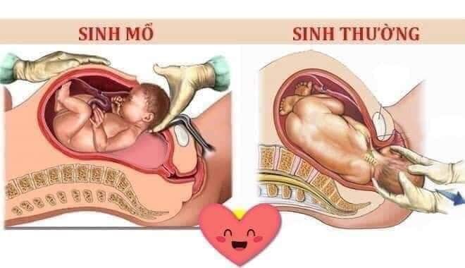 "😂Thiên hạ cứ như mình cô đẻ, xưa tôi đẻ 7-8 đứa, làm tới lúc đẻ, đẻ xong đã phải tự dậy nấu mà ăn, giờ có người dâng tận miệng còn giả bộ😂"_lời nói cay độc từ những người mang tên "người mẹ"

BẠN SINH THƯỜNG HAY SINH MỔ

NỖI ĐAU AI THẤU 😨

😴Sinh thường: sinh thường đều rách tầng sinh môm khâu không biết bao nhiêu mũi , hỏi bác sĩ thì Bác nói khâu tới đít. Người ta nói đẻ k sợ mà chỉ sợ khâu tầng sinh môn. M thấy rất đúng . Sợ đến ghê người đau đến thâú xương . Con được bác sĩ cho ra nhờ con dao rạch tầng sinh môn của mẹ. Sau đó là những tiếng kéo chiếc kim 1 sợi chỉ. Từng mũi đi qua đau muốn thấu tim. Đẻ k khóc nhưng bác sĩ khâu thì những giọt nước mắt đã chảy dài và luôn miệng hỏi bác ơi xong chưa? Cho em thêm thuốc tê đi ạ 😭 3 mũi khâu trong 3 mũi khâu ngoài cuối cùng 20p trôi qua cũng xong.

Khâu xong những ngày đầu không thể bế con cho con ti được phải quỳ chứ ngồi cũng k ngồi được đi cũng đau chỉ nằm thì đỡ được tý. Nhìn con khóc thương hại mãi mới quỳ sao để đỡ đau r cho con ăn . Lúc ngoan thì ti mẹ hẳn hoi lúc hắn hư hắn giãy nảy , mới lần đầu tiên làm mẹ cũng rối , vết thương đau đến chảy nước mắt cố đứng nhanh chóng dậy đưa con để k khóc nữa nhưng mẹ thì đau đến thâú xương.

Sinh xong rồi đi nhẹ đi nặng gì cũng là vấn đề nan giải , y tá bác sĩ ra vô hỏi thăm tiểu đc chưa ị được chưa hoài thôi , ko được là phải đặt thông tiểu . Những mẹ bị trĩ hoặc đi nặng bị táo k thể đi được máu cứ thế chảy ra. Ôi thôi, ám ảnh đến hết đời cũng k quên được.

Vậy nên các Mẹ không cần phải ăn kiêng quá đâu , ăn rau ăn canh , trái cây và sữa chua bình thường để đi nặng bớt bị thốn nhé 😞

💘Sinh Mổ: thì rạch 9 lớp mới cho được con ra. Khâu từng lớp lại những mũi tiêm tê tủy sống sẽ làm mẹ đau lưng buốt xương sống. Những vết mổ dài đi theo mẹ cả cuộc đời. Mỗi lần con sinh ra là lại xuống sức khỏe gấp bao nhiêu lần

Có 1 mẹ tâm sự với mình họ nói có mẹ nói "trước tao đẻ 4.5 đứa chả sao cả mà m có 1đứa mà như chết đi sống lại vậy".

đúng vậy khi bước vào phòng đẻ phòng mổ đó chính là đối diện với tử thần. Sau khi mổ xong thì bị cách ly con ít nhất vài tiếng , trong vài tiếng đó nằm đợi chờ và thuốc tê hết tác dụng thì bắt đầu đau nhói , nhích người một hút là đau điếng hết người, mỏi nhứt nhối từ trước ra sau, vã hết mồ hôi vì chịu đau có khi cả người lạnh như ướp băng , eo ôi cảm giác đó kinh khủng.

Sau đó là chuỗi ngày đi ko nổi , ko dám cười mạnh ko dám vận động mạnh vì sợ bung chỉ hoặc chảy máu trong , kiêng khem bao nhiêu thứ lợi sữa cho con nên các Mẹ sinh mổ thươngf bị ít sữa ngay từ đầu .

Nhiều mẹ ko cẩn thận vết mổ , bị nhiễm trùng hoặc có vấn đề gì thì còn mệt gấp trăm lần lúc mổ 😞 , về sau này cứ mỗi lúc trở trời vết mổ cứ nhói nhói lên khó chịu cực kỳ, lại đau đầu hay quên, mỏi lưng dã man.

Chỉ 1 lần thôi nhưng vết sẹo 10 phân đó mang theo cả cuộc đời mẹ. Đẻ 1 đứa là đánh đổi thanh xuân , sức khỏe thậm chí cả tính mạng ...

Vì thế hãy trân trọng những người phụ nữ , họ đã hi sinh rất nhiều cho bạn để có những đứa con kháu khỉnh, khỏe mạnh luôn rộn tiếng cười nhé.

Các ông chồng chẳng cần làm gì nhiều , chỉ cần quan tâm động viên an ủi vợ và cảm thông cho vợ trong thời gian chăm con nhỏ - vậy là đủ rồi!

Đừng vô tâm - phụ nữ dễ trầm cảm lắm!