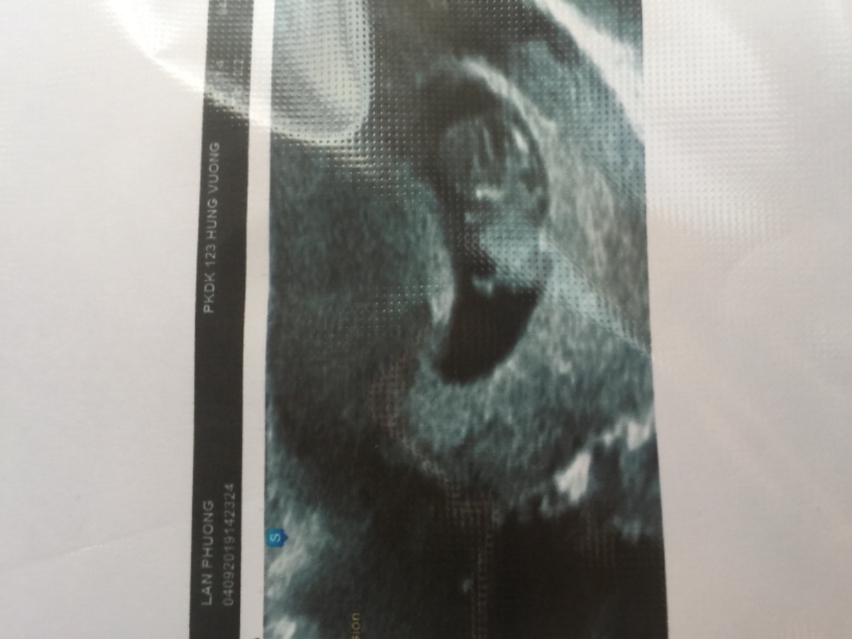 Em bầu 9 tuần nay do bị cảm nên đi khám bs bảo cảm nhẹ cho xịt mũi và súc miệng thôi.Khỏi siêu âm mà em kêu thôi siêu âm luôn coi con em có sao không ạ.thì siêu âm có túi dịch dưới túi thai.E không thấy đau bụng mấy cũng k ra huyết.Bs cho thuốc dưỡng về.Có ai bị giống e không ạ có sao k các m