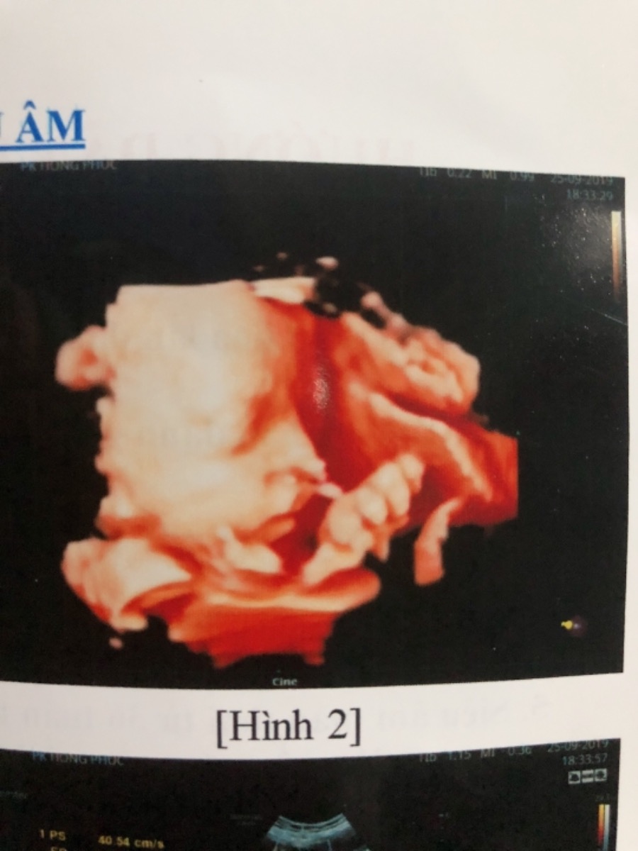 Mấy mom cho e hỏi ăn gì vào con ạ
E mới đi khám về bé 30w rồi mà có 1300 thôi ạ. Ai cũng bảo nhỏ😪😪
Mấy mom chỉ giúp e với ạ. E cám ơn nhìu