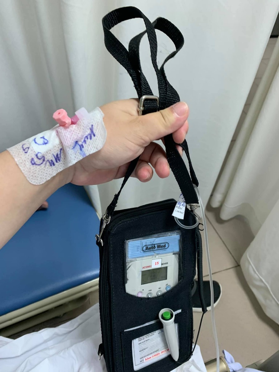 Review gói giảm đau sau mổ 3 triệu bệnh viện Phụ Sản Trung Ương
Chắc nhiều mẹ trước khi sinh mổ cũng phân vân giống như mình về việc có nên dùng gói giảm đau sau sinh hay không. 
Cá nhân mình cũng từng lưỡng lự vì nghe nhiều mẹ nói về các tác dụng phụ của thuốc (đau lưng), không giảm đau nhiều, sữa về chậm... Tuy nhiên do mổ lần 2, vốn lại nhát đau và chịu đau kém nên đến cuối cùng vẫn quyết định đầu tư gói này, và đây có lẽ là quyết định vô cùng đúng đắn.
- Thời điểm gắn máy: Thuốc được truyền vào người qua một đường ống vô cùng nhỏ cắm vào sống lưng. Ống này sẽ được gắn sau khi mổ xong, lúc nằm ở phòng hậu phẫu. Cụ thể là trước khi mổ mình đã trao đổi luôn với bác sĩ và ekip mổ của mình về việc muốn dùng gói giảm đau, sau đó khi nằm phòng hậu phẫu sẽ có một y tá phụ trách riêng đến hỏi han và gắn máy cho mình khi bắt đầu nhấc được chân.
- Cách dùng: Máy liên tục truyền vào người một liều thuốc giảm đau rất nhỏ theo một chu kì nhất định (Lắng tai nghe sẽ thấy thỉnh thoảng máy kêu e e. đó là lúc bơm thuốc). Còn khi nào đau quá thì bấm nút xanh lá kia, máy sẽ tự truyền một lượng thuốc nhiều hơn một chút để giảm đau nhiều hơn.
- Có bất tiện không? Xin trả lời là KHÔNG. Sau khi gắn ống truyền bé xíu vào lưng mình, y tá sẽ cố định bằng một loại băng dính siêu chắc, nên mổ xong nằm trở mình thoải mái không sợ tuột. Trên máy thì có một quai đeo, nên khi muốn đi lại thì chỉ cần đeo máy lên vai là xong.
- Có đỡ đau không? ĐỠ VÔ CÙNG. Gần như mình chỉ cảm thấy hơi nhói đau khi có cơn co hồi tử cung. Nói chung là đau ít hơn lần 1 rất nhiều. Và sau 3 ngày, khi rút máy ra thì cũng không hề đau chết đi sống lại như nhiều mẹ bảo. Bởi khi đó tử cung của mình đã co được rất nhiều. Có đau thì đau một chút rát rát khi đi lại do đầu chỉ ở vết mổ thôi. 😌
- Có mất sữa không? KHÔNG HỀ. Tối ngày thứ hai sau khi mổ là sữa mình đã bắt đầu về, sang ngày thứ ba là còn về nhiều cương ngực cơ ạ. 
- Hằng ngày sẽ có một nhân viên phụ trách giảm đau đi đến tận giường để kiểm tra tình trạng mày, xem còn thuốc hay không, nếu hết thuốc thì sẽ bơm thêm. Dù là giữa đêm mà máy không chạy thì chỉ cần alo số điện thoại, sẽ có nhân viên tức tốc đến kiểm tra cho bạn 🥰
Tóm lại là với mình thì gói giảm đau này rất nên dùng!!!!!!