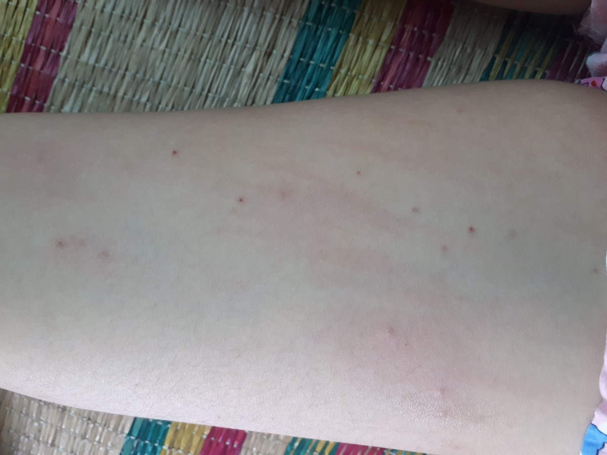Có mom nào bị như e k ạ 😭 cứ sáng ra đi làm mang quần dài trưa về thay ra thì lại nổi hột ngứa hết cả lên, gãi thì chảy máu như này ạ. Mom nào có cách chỉ e với ạ. E bầu đc 14w4d rồi ạ 😓 em cảm ơn