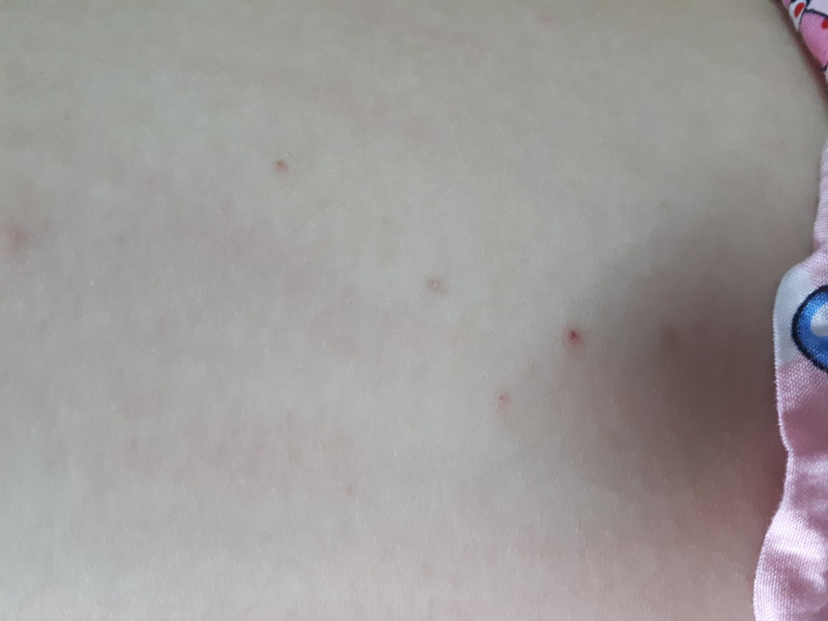 Có mom nào bị như e k ạ 😭 cứ sáng ra đi làm mang quần dài trưa về thay ra thì lại nổi hột ngứa hết cả lên, gãi thì chảy máu như này ạ. Mom nào có cách chỉ e với ạ. E bầu đc 14w4d rồi ạ 😓 em cảm ơn