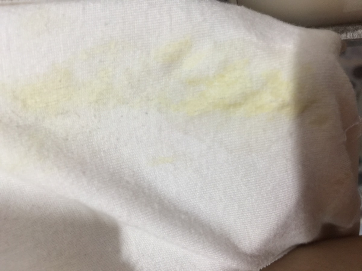 Mình đc 18t, mà âm đạo ra khí hư vàng nhạt như vậy, ko ngứa, không có mùi hôi, có sao không mọi người, mom nào có kinh nghiệm xem giúp mình với :(