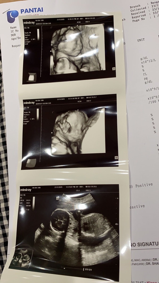 Các mom oi cho e hỏi ảnh đầu tiên có phải bé đang cười đúng k ạ?? Do e mới có bầu lần đầu nên không biết đúng hay k ạ.
