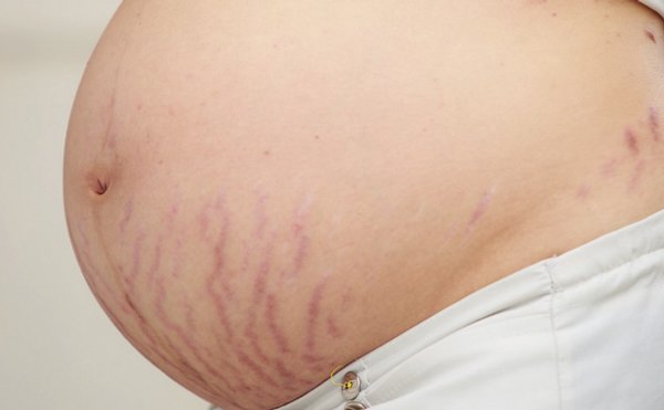 Rạn da khi mang thai: nguyên nhân và kinh nghiệm khắc phục hiệu quả