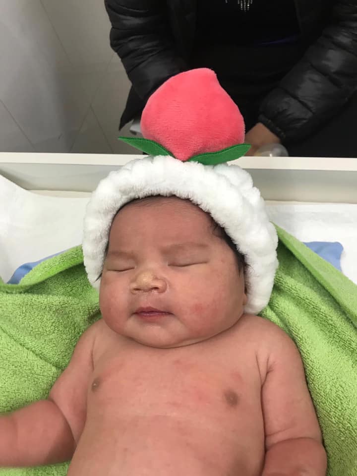 Hôm nay mình xin phép rv cho các Mom về dịch vụ đẻ Mổ tại D3, bệnh viện Phụ Sản Hà Nội ạ.
Hiện tại mình sinh bé đc 9day rồi. Bé nhà mình tròn 40w. 4150gram. Nữ ạ.

Buổi sáng ngày 4/12 là ngày dự sinh. Nhưng bé vẫn chưa có dấu hiệu muốn ra. Mẹ con mình đã làm tất cả các xét nghiệm. Bé đã được 3kg9, Chỉ có cơn gò 1 chút. Tử cung còn cao, không mở phân nào.
Mẹ xin bác sỹ cho ở lại theo dõi, nhưng vì hôm đó bệnh nhân kín phòng, không còn giường. Nên mẹ lại được bác sỹ cho về. Vì vẫn mong muốn được sinh thường, nên mẹ vẫn quyết định lì cùng con.

Tối đó lúc 20h45. Mẹ có dấu hiệu rỉ ối, tính vào phòng vệ sinh kiểm tra thì ối vỡ đầm đìa. Vì là lần đầu tiên nên mẹ rất lo và gọi người nhà cho vào viện gấp.

Vào tới phòng cấp cứu là 21h30, khoa dịch vụ nhà B, đứng giữa phòng chưa kịp nói gì, nước ối tràn ra nhà (dù đã đóng bỉm). Nước ối bị đục của phân su, bác sỹ cho lên bàn kiểm tra gấp. (Nước ối vẫn không ngừng chảy). Nhưng cổ tử cung vẫn cao và không mở phân nào.
Bác Sỹ nói "chuẩn bị tinh thần mổ cấp cứu" mà nước mắc trực rơi vì sợ.
Sau 10p làm qua các thủ tục và tạm ứng 21tr. (vì mẹ đã đăng ký đẻ từ tuần 36 rồi, nên thủ tục đã xong). Mẹ được đẩy lên khoa dịch vụ nhà D3 để cấp cứu.
Sau khi nghe bác sỹ nói qua về tình hình của mẹ (phân su đã bẩn ối, vỡ ối non, bé quá to không thể sinh thường, cổ tử cung không có dấu hiệu mở...). Người nhà ký cam kết và mẹ được chuyển về phòng mổ. Lúc 22h.
Tại đây mẹ được gây tê màng cứng. Mẹ không đăng ký chỉ định bác sỹ nào. Vì ngay từ đầu chưa có kinh nghiệm nên mẹ không theo bs nào. Nên hôm đó mẹ được Bác Sỹ Nguyễn Hùng Sơn (Sơn B ) mổ cho. Bác sỹ và ê kíp mổ rất nhẹ nhàng, chu đáo. Chỉ có mẹ là lo lắng nên không dám nói nửa lời, từ lúc vào phòng mổ cho tới lúc ra khỏi phòng mổ.
Bé được chào đời lúc 22h30. Sau gần 1 tiếng đồng hồ nhập viện. Trộm vía bé cứng cáp nhất phòng.
Mẹ đăng ký truyền giảm đau 48 tiếng (giá hơn 3tr5 hay sao ấy). Nên mẹ không bị đau nhiều như các Mom khác. Nhưng lúc hết thuốc giảm đau thì cũng ghê lắm 😭
Mẹ được da kề da với bé khoảng mấy phút. Sau đó bé được trao tay cho người nha. Và chuyển lên khoa sơ sinh nằm đợi mẹ về phòng.
Mẹ và con cách ly nhau từ đây. Mẹ được đưa tới khoa hồi sức sau mổ (nằm 6 tiếng) nhưng thực ra mẹ nằm tới tận 8h30 sáng ngày 5/12. (Rất may mắn mẹ được có giường luôn)
(Time này là quãng time kinh khủng nhất). Mẹ và các Mom khác nằm đợi từng phút để tới sáng. Ai cũng bị phản ứng phụ của thuốc gây tê màng cứng. Run rung cả giường, rét run cầm cập, mệt, đói, khát.... nhớ con.... người nhà thì lưu lạc khắp nơi, không biết ở đâu. => vì mẹ về phòng, con mới về phòng, người thân mới có phòng....
Ngày hôm mẹ đẻ thì bệnh viện full giường. Có những Mom nằm nguyên 1 ngày mới có giường để chuyển về. Cảm giác ấy đáng sợ lắm....
Khi về tới phòng rồi, được gặp con, gặp người nhà rồi thì hạnh phúc lắm....
Trộm vía con khoẻ mạnh nên bé được về với mẹ luôn. Còn 1 số mom khác con có bất thường gì là bé phải nằm cách ly mẹ để theo dõi. Nhớ con thương con lắm mà không được gặp con.

Mình thuê phòng dịch vụ 1tr/ngày. (1 phòng có 2 giường)
Mọi thứ khá ổn. Buổi sáng bác sỹ kiểm tra Nhi, bác Sỹ kiểm tra mẹ, yta phát thuốc, vệ sinh cho mẹ 2 lần/ngày, tắm bé 1 lần/ngày.

Mình đăng ký thêm chiếu tia plasma cho nhanh lành vết thương, giảm đau,... vì đẻ mổ nên mình chiếu 2 lần/ngày. Mỗi lần 300k.
=> các mẹ nên chiếu tia plasma này nhé, vì mình thấy vết thương khô mà liền nhanh lắm.

Ngoài ra mình đăng ký massa cho bé, 1 ngày 1 lần. 200k/lần.
Mình nằm 3 ngày tại bệnh viện là được về rồi. Đi lại hơi đau chút, nhưng mình vẫn tự đi lại được.

Tất tần tật chi phí đi đẻ của mình hết 28tr500 (chưa tính chi phí đăng ký đẻ, khám thai từ tuần 36 - cái này cũng tốn lắm 😭)

Hiện tại vết mổ của mình đỡ đau rồi. Chỉ cần đi lại nhẹ nhàng là được. Mẹ đã có sữa từ ngày thứ 4, tuy ít nhưng vẫn đang cố gắng, con đã rụng rốn từ ngày thứ 5. Trv mọi thứ vẫn đang ổn...

Mẹ con mình Chúc các Mom mẹ tròn con vuông. Có thêm nhiều kinh nghiệm đi đẻ mà không bỡ ngỡ như mình. Ai muốn hỏi gì cứ cmt mình sẽ trả lời hết ạ.