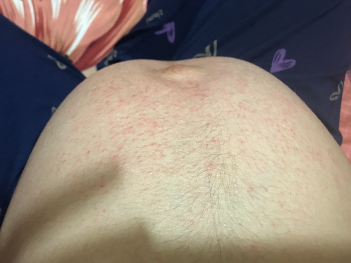 Các mom ơi cho mình hỏi với 2 hôm nay mình bị mẩn ngứa vùng bụng như thế này. Mà ngứa lắm ấy . Nay mình được 21 tuần . Đi khám thì bs bảo ko sao do thay đổi nội tiết. Nhưng mình ngứa điên đảo? Các mom có cách naog hết ko ạ chỉ mình với