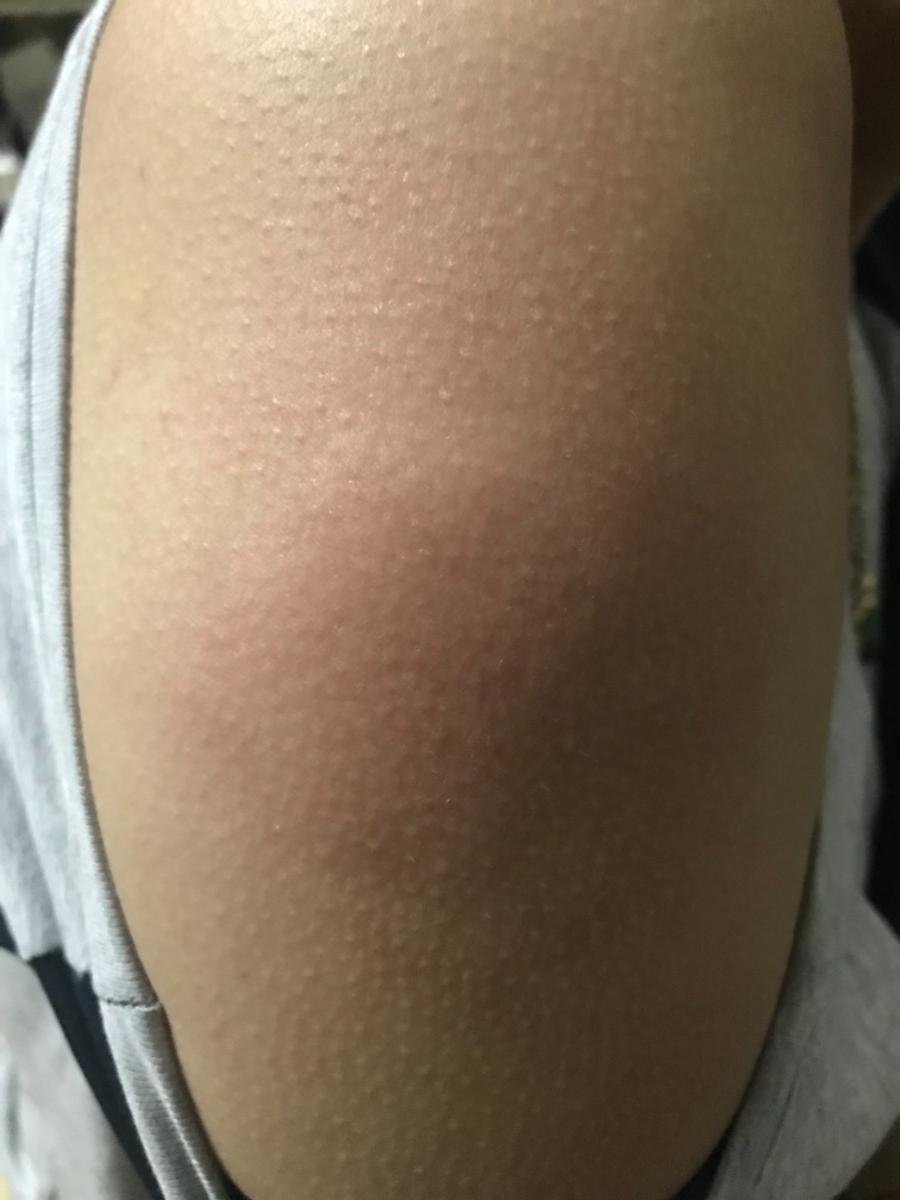 Các mom đi tiêm uốn ván về có bị sưng đau và ngứa ko? Mình tiêm từ chiều thứ 7 mà từ qua đến nay sưng đau và ngứa khủng khiếp