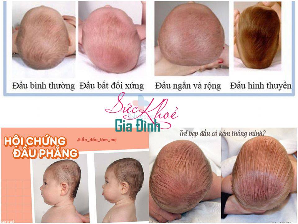 TRẺ SƠ SINH BỊ BẸP ĐẦU: TƯỞNG CHUYỆN NHỎ MÀ HẬU QUẢ KHÔNG NHỎ!

Lần rồi về Việt Nam thấy thằng cháu có cái đầu dẹp lép như con cá trê quá tội, mà nó lớn rồi nên tôi không còn làm gì được. Hôm nay ở Mỹ thì khám một ca hội chứng khớp thái dương hàm (Temperomandibular Joint Syndrome TMJ) khá nặng. Cô gái xinh xắn 16 tuổi mà hàm dưới mở nửa đường thì kẹt, nói, nhai hay ngáp đều đau đớn. Coi kỹ thì thấy cô này đầu có hình dạng bất thường, xương mặt và mắt bên lớn bên nhỏ. Lại thêm một trường hợp đầu bẹp không được chữa trị đúng và kịp thời.

Bệnh trẻ sơ sinh bị bẹp đầu dễ phòng ngừa và có thể điều trị, hơn nữa gần đây cách trị liệu có nhiều kỹ thuật mới cải tiến chứ không như ngày xưa. Nên các mẹ nhớ lưu ý, đừng để con lớn lên có cái đầu dẹp lép thì tội nghiệp nó lắm.

Bệnh đầu bẹp là gì?

Bệnh hay gặp ở trẻ nhỏ từ sơ sinh tới 6 tháng tuổi khi xương sọ đang phát triển và còn rất mềm, do xương sọ bị tác động ngoại lực đè ép kéo dài, thường là phía sau đầu do nằm ngửa lâu kéo dài, khiến xương sọ vùng đó bị dẹp, phẳng, đồng thời xương sọ bị ép phải phát triển ngược lại về hướng không bị ngoại lực. Cuối cùng làm cho sọ phát triển dị dạng bất thường, dẫn tới dị dạng mặt và các phần khác của xương đầu.

Bệnh có hai dạng chính:

Plagiocephaly: đầu lép phía sau ở một bên, làm cho xương sọ phát triển về phía trước của bên đó.

Bradycephaly: toàn bộ phía sau bị lép, phía sau đầu sẽ phẳng lì, giống như hình chữ nhật.

Còn có thêm loại kết hợp đặc điểm của hai loại trên.

Nguyên nhân khiến đầu bẹp

Hầu hết do nằm nhiều ở một tư thế cố định. Trẻ sơ sinh nằm ngửa suốt ngày, xương sọ mềm, nên sẽ bị bẹp phía sau (bradycephaly). Nếu chỉ xoay đầu sang một bên do tư thế hay do vẹo cổ (torticollis) sẽ làm bẹp một bên phía sau gây plagiocephaly.

Ngoài ra còn một số nguyên nhân khác như:

- Tư thế trong tử cung: khung chậu hẹp, u bướu, mang thai nhiều con cùng một lúc dễ làm xương sọ biến dạng.

- Sinh non: nhiều bệnh nằm lâu, sọ mềm.

- Các tác động bên ngoài khác như ghế an toàn, ghế xích đu,…

Bệnh đầu bẹp có hay gặp không?

Bệnh rất phổ biến từ sau khuyến cáo phòng ngừa SIDS (đột tử ở trẻ sơ sinh) của AAP năm 1992 khuyên cho trẻ nằm ngửa khi ngủ. Trước đó cứ 300 bé có một bé mắc bệnh này, sau đó thì 10 bé có 1 bé mắc bệnh. Ở Việt Nam có thể còn cao hơn rất nhiều do chưa được chú ý hay hướng dẫn.

Trẻ sơ sinh bị bẹp đầu gây tác hại gì?

Nếu bị nhẹ thì không có tác hại gì đáng kể ngoài có cái đầu hơi méo méo chút, sau này lớn chỉ đổi kiểu tóc là ổn. Nếu nặng thì có nhiều tác hại về lâu dài ảnh hưởng cuộc sống khi bé lớn.

Đừng tưởng chỉ có cái đầu dị dạng chút thôi không có gì nghiêm trọng. Khi xương sọ dị dạng đủ nhiều, sẽ làm dịch chuyển các cấu trúc của nền sọ. Hãy tưởng tượng cả cái đầu là cái nhà của bạn, nền sọ như là cái móng nhà, xương sọ là cái khung nhà, khuôn mặt là mặt tiền nhà, còn hàm dưới như cửa lớn của cái nhà. Nếu cái móng nhà méo mó, dị dạng thì các cấu trúc xây trên nó sẽ như thế nào?

Cái đầu thì méo xẹo, tóc kiểu nào cũng xấu, không lẽ đội mũ tối ngày. Dung nhan sẽ tổn hại vô cùng, tai thì bên cao bên thấp, bên lớn bên nhỏ, mắt và mặt cũng bên lớn bên nhỏ, mũi thì vẹo. Cái "cửa nhà" thì đóng không khớp, mỗi lần mở ra đóng vô là nó rên rỉ (bệnh khớp thái dương hàm). Khớp cắn thì lệch, hàm dưới thì trề ra ngoài, dễ đổ thuốc. Chết thì không chết nhưng đau khổ kéo dài vô cùng. Tới lúc này thì chỉ còn nước oán trách cha mẹ với bác sĩ nhi của mình mà thôi.

Nghiên cứu mới nhất của Seattle Children's Craniofacial Center cho thấy trẻ bị bệnh đầu bẹp lúc nhỏ có điểm về nhận thức, tư duy và trí nhớ kém hơn các trẻ không bị bệnh đầu bẹp. Đồng thời trẻ có bệnh đầu bẹp cũng có kết quả học tập kém hơn các trẻ không mắc bệnh. Như vậy bệnh này không chỉ làm xấu xí mà còn ảnh hưởng tới não bộ nữa nha các mẹ.

Có thể phòng ngừa bệnh đầu bẹp cho con như thế nào?

👨🏻‍⚕️Với bác sĩ Nhi:

PHẢI HƯỚNG DẪN cha mẹ chăm sóc đầu từ lần khám đầu tiên, tiếp tục theo dõi trong các lần khám tiếp theo 2-4-6 tháng nhằm phát hiện sớm, tiếp tục hướng dẫn và điều trị kịp thời.

👨‍👩‍👧‍👦Với cha mẹ:

Đã biết đầu bẹp là do nằm nhiều thì cha mẹ phải siêng năng thay đổi tư thế bé, tăng thời gian nằm sấp CÓ GIÁM SÁT (vì trẻ dưới 4 tháng đầu còn yếu và chưa xoay trở được sẽ có nguy cơ bị ngạt nếu nằm sấp.)

Có người bảo cho nằm gối mềm. Xin thưa là Hiệp Hội Nhi Khoa Hoa Kỳ (AAP) khuyến cáo nằm ngửa và trên mặt phẳng tương đối cứng, không có gối hay miếng lót xung quanh vì tăng nguy cơ đột tử.

Tăng thời gian nằm sấp (tummy time) bằng nhiều cách tùy theo lứa tuổi:

- Từ 0-2 tháng, cơ cổ còn yếu, cho bé nằm sấp trên ngực, vừa tăng tình cảm vừa ngừa đầu dẹp. Cổ cứng hơn chút thì cho nằm sấp, ấn nhẹ vùng hông cho bé tập nâng đầu.

- Từ 3-6 tháng, cho bé nằm sấp chơi nhiều hơn, dùng gương, đồ chơi dụ cho bé nâng đầu và rướn người vể trước.

- 6-9 tháng, các bố ít đi nhậu lại mà về chơi tàu lượn, xích đu tiên với con, bé sẽ mau biết bò hơn.

Còn trẻ bị vẹo cổ (Torticolis) hay có xu hướng chỉ trở đầu qua một bên thì sao? Cũng dễ thôi. Trẻ sơ sinh vẹo cổ là do cơ vùng cổ ngắn hơn ở một bên và co kéo về bên đó nhiều hơn, bây giờ phải tìm mọi cách cho trẻ xoay đầu sang bên kia nhiều hơn.

Ví dụ như trẻ luôn xoay đầu sang trái thì:

- Đổi tay cho bú, lót tay dưới cổ bên phải để bé nghiêng cổ về bên phải.

- Khi bé nằm trong nôi hay giường, xoay tư thế sao cho bé phải xoay đầu sang phải để tìm mẹ.

- Luôn bắt đầu chạm vào bé từ phía bên phải, để bé xoay đầu sang phải.
- Bế bé ở tư thế xoay mặt ra ngoài, để bé tò mò mà xoay đầu theo mọi hướng.

- Nếu bé vẹo cổ thì tập vật lý trị liệu cơ cổ với liệu pháp cằm-vai và tai-vai (chin-shoulder và ear-shoulder), mỗi đợt 10-15 lần, 5-6 đợt một ngày.

Cằm-vai; một tay giữ vai trái, tay kia từ từ xoay nhẹ đầu sang phải cho đến khi cằm đụng vai phải, giữ 10-15 giây thì buông ra. Lặp lại 10 lần, mỗi ngày làm 5-6 đợt như vậy.

Tai-vai: một tay giữ vai trái, tay kia đẩy nghiêng đầu sang phải cho đến khi tai phải chạm vai phải, thời gian và tần suất tương tự như cằm-vai.

Điều trị bẹp đầu cho trẻ như thế nào?

Não bộ và xương sọ phát triển nhanh nhất trong 6 tháng đầu đời, sau đó chậm lại cho đến 18 tháng thì các khớp nối xương sọ hoàn toàn dính liền với nhau và xương sọ định hình vĩnh viễn. Do đó THỜI GIAN VÀNG để bắt đầu điều trị là 4-6 tháng tuổi. Cho tới 12 tháng tuổi thì hiệu quả điều trị sẽ giảm nhưng vẫn cho kết quả tốt. Sau 12 tháng hiệu quả giảm dần, tới 18 tháng tuổi thì đành chấp nhận thương đau.

Trường hợp vừa và nặng, trẻ được cho đeo một cái mũ helmet đặc biệt suốt ngày đêm ngoại trừ lúc tắm cho đến khi đầu tròn trở lại.

Ngày xưa, cái mũ này làm theo kiểu one size-fit-all (chỉ một cỡ duy nhất) nên hiệu quả có hạn chế vì đó là điều trị thụ động. Khoảng 15 năm trở lại đây, công ty Cranial Technology của Mỹ và nhiều nơi khác đã phát triển một phương pháp điều trị mới dựa trên kỹ thuật mới gọi là Digital Surface Imaging. Họ dùng một cái máy camera lớn như cái máy CT scan có thể chụp 360 tấm hình trong một phút. Máy sẽ chụp rất nhiều hình của đầu bé, sau đó các hình ảnh được sử dụng để tạo một hình 3D của đầu bé, giống y hệt như đầu của bé từ kích thước đến cấu trúc. Từ hình ảnh này, họ sẽ làm ra một cái mũ gọi là DOC band, vừa khít với đầu của TỪNG BÉ. Mũ sẽ được thiết kế sao cho tạo nhiều áp lực lên vùng bị lồi ra và ít áp lực lên vùng lõm. Bằng cách đó, họ "bắt buộc" xương sọ và nền sọ phải phát triển theo hướng ngược lại cho đến khi đầu tròn trở lại. Bé sẽ được theo dõi mỗi tuần một lần để điều chỉnh mũ cho phù hợp.

Xin chú ý là hiện nay ở Việt Nam bệnh này còn chưa được chú ý đúng mức và chưa có các phương pháp điều trị được kể phía trên. Nên hiệu quả nhất vẫn là PHÒNG NGỪA, nếu lỡ bị thì vẫn áp dụng các biện pháp được nêu trong bài sẽ cải thiện một phần, hoặc có thể tìm những loại mũ đơn giản.

Quá trình điều trị mất 3-9 tháng tùy mức độ nặng nhẹ và thời điểm bắt đầu.

Con mình đẻ ra đẹp trai đẹp gái, ráng mà chăm sóc phòng ngừa đầu dẹp nha các ba mẹ.

Chúc mọi người nuôi con thành công và đừng bao giờ để các em bé sơ sinh bị bẹp đầu!

Nguồn :Bác sĩ Trương Hoàng Hưng từ Texas, Hoa Kỳ