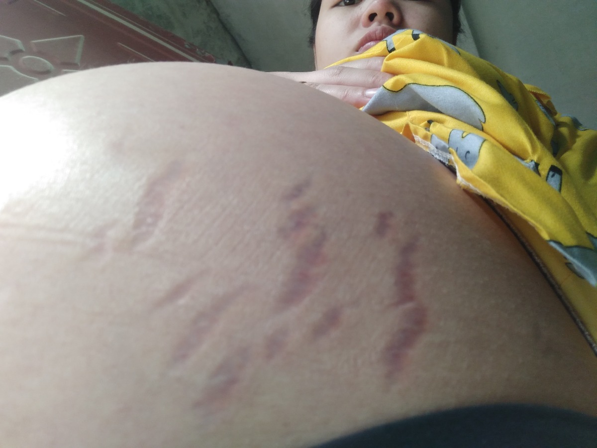 Có mom nào biết dùng kem gì để đỡ vết rạn này không ạ