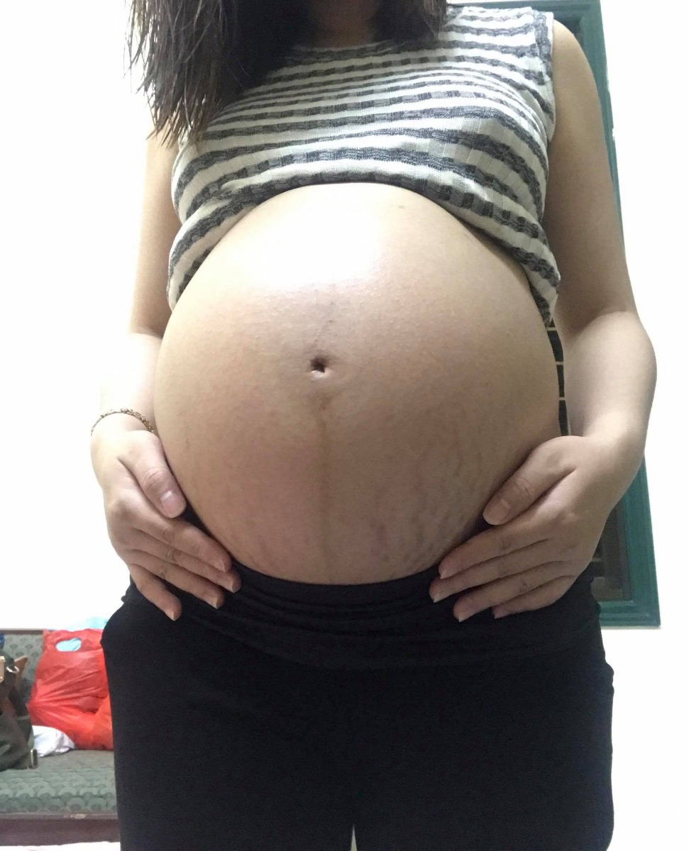 32w6d của e đây ạ. Các mom khoe bụng bầu đi. E tập đầu do cơ địa da mỏng nên dù có bôi đâu dừa với kem rạn của nhật vẫn k ăn thua đây 😅😅