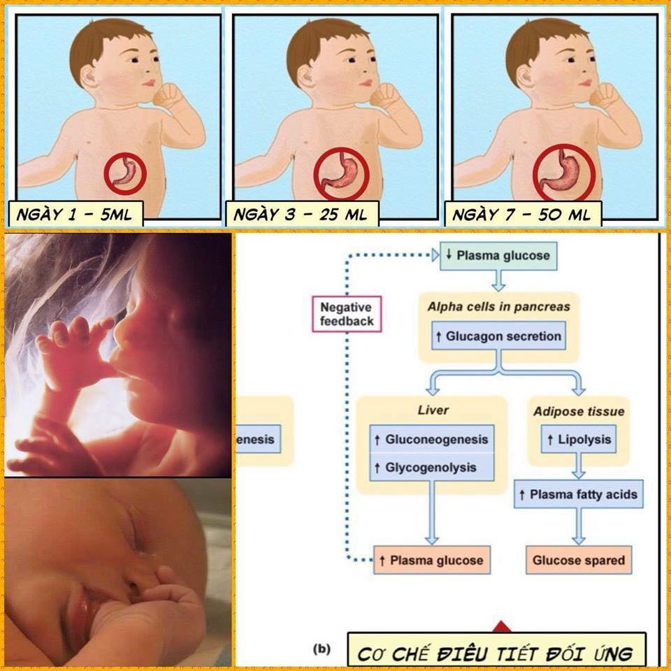 "DUNG TÍCH DẠ DÀY TRẺ SƠ SINH VÀ CƠ CHẾ ĐIỀU TIẾT ĐỐI ỨNG"

Cm thường chia sẻ : "Em cũng cho con bú sữa non, tuy nhiên sữa non quá ít, nên bé vẫn phải bú thêm sữa ct, cho đến 5 ngày sữa mẹ mới về đủ cho bé bú." Nên hiểu vấn đề này thế nào cho đúng?

Ảnh minh hoạ: Bé có phản xạ mút bú từ trong bụng mẹ, và các phản xạ khác khiến bố mẹ có cảm giác bé rất đói và cần bú thật no, nhưng thật ra bé không bị đói, trong 72 giờ đầu đời, nhờ cơ chế điều tiết đối ứng.
**Mô tả dưới đây áp dụng cho trẻ sơ sinh đủ cân (2.5kg< cân nặng khi sinh <4kg), sinh đủ tháng (>37 tuần thai), mẹ và thai nhi k có bệnh lý tiểu đường.**

Cơ sở khoa học:

A - Trong bào thai:

1- Dinh dưỡng thụ động và liên tục: Trong thai kỳ, thai nhi được cung cấp dưỡng chất từ mẹ qua dây nhau. Dinh dưỡng này có đặc điểm "thụ động" (không cần thông qua hệ tiêu hoá). Dưỡng chất được cung cấp liên tục cho thai nhi, mặc dù vào quý 3 thai kỳ, thai nhi có thực tập tiêu hoá một lượng nhỏ nước ối rất nhỏ hệ tiêu hoá vẫn chưa thật sự hoạt động, chưa có cảm giác "trống/ đầy", "đói/ no".

2- Phản xạ mút không dinh dưỡng (non-nutritive sucking reflex): Từ trong quý 2 của thai kỳ, bào thai đã bắt đầu có phản xạ mút tay, mút mạnh và liên tục, không phải vì đói không phải để tiếp nhận dinh dưỡng, phản xạ này giúp các cơ thực hiện động tác mút, vắt, nuốt được thực hành thuần thục để các cơ đủ mạnh để bú mẹ sau này.

3- Sữa non của mẹ: từ giữa thai kỳ sữa non được tạo sẳn trong tuyến vú để chuẩn bị cho trẻ bú khi mới sinh ra đời.

4- Năng lượng dự trữ: Ngoài việc cung cấp dinh dưỡng cho bé, cơ thể mẹ còn tạo năng lượng dự trữ cho bé dưới 2 hình thức: glycogen ở gan và mô mỡ trắng trong cơ thể. Đặc biệt, trong quý 3 của thai kỳ, thai nhi nhanh chóng được tích tụ mô mỡ, ở thời điểm chào đời, mô mỡ chiếm khoảng 15% trọng lượng cơ thể (cao nhất so với tỉ lệ mô mỡ ở các sơ sinh các loài khác). Trong đó, mô mỡ nâu có tác dụng giữ ấm cho một số vùng quan trong trong cơ thể bé chiếm 3% - 5%, còn lại là mô mỡ trắng làm năng lượng dự trữ chiếm 12% - 10%.

B - Khi bé sơ sinh chào đời:

1- Sữa non của mẹ: trong 3 - 7 ngày đầu đời, sữa mẹ có sẳn trong vú mẹ cung cấp cho bé lượng sữa từ 5ml - 10ml/ cử và từ 10 - 14 cử/ ngày. Phù hợp với dung tích dạ dày và hệ tiêu hoá chưa hoàn chỉnh của bé, phù hợp với nhu cầu bảo vệ của bé trong môi mới.

2- Dung tích dạ dày: Dung tích trung bình của trẻ sơ sinh như sau: 
+ Ngày 1: 5ml - 7ml, có nghĩa 1 cử bú tương đương 1 - 1.5 muỗng cafe (thìa nhỏ) 
+ Ngày 3: 25ml, tương đương 5 thìa nhỏ cho mỗi cử bú
+ Ngày 7: 50ml
+ Ngày 10: 75ml
+ Từ 1 - 6 tháng: 100ml (dung tích dạ dày bé hầu như không thay đổi từ 1 - 6 tháng)
Số cử bú có thể theo nhu cầu của bé, khoảng 14 cử trong ngày đầu đến 10 cử sau tuần đầu và 8 cử sau tháng đầu.
Một số bé không biết cảm giác đói no, mà có bao nhiêu cũng bú, vừa bú xong lại có biểu hiện chưa no, do biểu hiện của "phản xạ bú mút và phản xạ tìm vú" (sucking reflex and rooting reflex), khiến bố mẹ cho trẻ sơ sinh bú thêm >30ml sữa ct/ cử, cho đến khi căng cứng bụng hoặc nôn trớ và dẫn đến tình trạng trào ngược thực quản khá phổ biến hiện nay! (Betibuti sẽ viết riêng 1 bài viết về cấu tạo dạ dày sơ sinh để cm tham khảo thêm.)

3- Kho dinh dưỡng và năng lượng dự trữ: Ngoài lượng glycogen và mô mỡ được dự trữ trong cơ thể bé ở quý 3 thai kỳ. Vào thời khắc chào đời, các mao mạch và mạch máu giản nở đồng loạt, tạo áp suất thấp trong hệ tuần hoàn sơ sinh, rút hết lượng máu lớn trong nhau thai và dây nhau vào cơ thể bé. Do đó vào thời điểm này, tổng lượng glycogen dự trữ ở trẻ sơ sinh nhiều gấp 3 lần lượng glycogen dự trữ ở người lớn, theo tỉ lệ trọng lượng cơ thể.

4- "Cơ chế Điều tiết Đối ứng (counter-regulation), sử dụng năng lượng dự trữ, đảm bảo dinh dưỡng liên tục ngay sau khi chào đời:
Sau khi trẻ sơ sinh bị cắt rời khỏi dây nhau, nồng độ đường glucose trong máu trẻ sơ sinh giảm nhanh (hạ đường huyết sơ sinh sinh lý - không phải hạ đường huyết bệnh lý). Hiện tượng này (a) kích thích tuyến tuỵ tạo hocmon GLUCAGON và kích hoạt cơ chế "điều tiết đối ứng" và (b) kích thích hocmon stress cortisol cần thiết ngắn hạn để kích hoạt một số tuyến thần kinh, hócmon và men (nuôi dưỡng sinh học, bao gồm được mẹ ấp tiếp da và bú mẹ sớm, giúp giảm hocmon stress sau thời điểm cần thiết này.)
Dưới tác động của hocmon glucacon, glycogen dự trữ được phân huỹ thành glucose (glycogenolysis) và mô mỡ trắng được phân huỹ thành axit béo tự do và glucose (lipolysis), cung cấp đường cho não và năng lượng liên tục, đặc biệt hiệu quả trong trong 72g đầu đời.

5- "Cơ chế lập trình đầu đời" và lợi ích của sữa non: Betibuti đã có một bài viết chi tiết riêng mô tả "Giờ Vàng của Sữa non và Cơ chế Lập trình đầu đời" và nhiều bài viết khác mô tả thành phần và tác dụng thần diệu của sữa non của mẹ ruột đối với bé sơ sinh của mình trong bài "Sữa non - Thần dược" (Cm nên tìm đọc các bài này trên trang FB Betibuti).
Như vậy, khi bé mới chào đời chỉ bú sữa non rất ít, phù hợp với dung tích dạ dày và đặc tính chưa hoàn chỉnh của hệ tiêu hoá sơ sinh. Bé nhận lactose từ sữa non và glucose từ glycogen dự trữ và glucose + axit béo tự do từ mô mỡ trắng dự trữ, đảm bảo bé liên tục được cung cấp đủ năng lượng cho suốt thời gian niêm mạc ruột chỉ tiếp nhận sữa non "lập trình đầu đời".

6- "Phản xạ tìm vú, và phản xạ mút /mút tay/ muốn được mút" (rooting reflex and sucking reflex): Ngoài phản xạ mút tay, mút lưỡi (như đã quen trong thai kỳ), trẻ sơ sinh còn có phản xạ tìm vú, khi có bất kỳ vật gì chạm vào má, đầu mũi, hay quanh miệng, trẻ sẽ quay về phía đó và tìm vú mẹ/ hay bất cứ cái gì mút/ bú được. Phản xạ này thường xuyên xảy ra khi bé thức hoặc ngủ, lúc đói cũng như lúc no, do đó, không phải lúc nào bé muốn mút hay tìm vú mẹ cũng là biểu hiện bé đói.

7- "Phản xạ khóc sơ sinh": Bé sơ sinh khóc vì nhiều lý do, vd. đau, lạnh vi k dc giữ theo thân nhiệt của mẹ, k cảm thấy mẹ, k an tâm, bị kích động bởi nhiều âm thanh lạ xung quanh,... không phải lúc nào bé khóc, cũng là bé đói!

8- Hiện tượng giảm cân ở trẻ sơ sinh: Hoàn toàn tự nhiên, bé có thể giảm cân trong 3 ngày đầu, trung bình 7% - 9%, do một phần nước ối còn trong phổi và nội tạng được xuất ra ngoài ngay sau khi sinh, và một phần glycogen và mô mỡ được sữ dụng. Tuy nhiên, trọng lượng của bé thường sẽ tăng lại từ ngày thứ 4, giúp bé đạt đến cân nặng khi sinh sau 10 - 14 ngày.

Vì thế mẹ cần hiểu kỹ hơn nhu cầu và các phản xạ của bé, cấu trúc cơ thể bé để phân biệt các biểu hiện và phản xạ của bé, và có nhiều cách để đáp ứng đúng các nhu cầu của bé. Betibuti đã có một bài viết chi tiết riêng mô tả "Nuôi dưỡng sinh học" mô tả các nhu cầu của trẻ sơ sinh và cách nuôi đúng để bé giảm khóc và phát triển tối ưu. Cm nên tìm đọc và áp dụng.

Kết luận:
Vậy chúng ta cần hiểu và áp dụng thế nào cho đúng, trong 3 ngày (72 giờ) đầu của bé:

Cách 1 -
Không quan tâm hoặc không tin tưởng rằng trẻ sơ sinh có sẳn một kho năng lượng dự trữ dồi dào và khả năng sử dụng năng lượng dự trữ tự nhiên, nhanh chóng và hiệu quả của cơ chế điều tiết đối ứng.
Cảm thấy sữa non của mẹ quá ít (=1 muỗng cafe), mẹ tưởng con cần bú nhiều hơn, thấy con hay khóc tưởng con còn đói và cho con bú thêm sữa ct >30ml/ cử để chờ sữa mẹ về 5 - 7 ngày sau khi sinh (sữa già)?

Cách 2 -
Tin tưởng rằng bé có kho năng lượng dự trữ dồi dào và cơ chế điều tiết đối ứng cung cấp cho bé đủ năng lượng đến 72 giờ liên tục như lúc bé vẫn còn được nuôi trong bào thai và áp dụng pp nuôi dưỡng sinh học càng sớm càng tốt trong những ngày đầu đời?

Hiểu lợi ích của "72 giờ vàng" đầu đời và lợi ích của "sữa non - thần dược", hiểu được dung tích dạ dày sơ sinh của con chỉ khoảng 5ml - 7ml, như vậy con bú sữa non của mẹ cũng chỉ 5ml - 10ml x 12 - 14 cử/ ngày, mà hoàn toàn k cần bổ sung sữa ct?
Hiểu rằng việc con bú mẹ 100% ngay từ sơ sinh, giúp sữa mẹ nhanh chóng gia tăng dung lượng trong vòng 2, 3 ngày, từ trung bình 5ml/ cử đến trung bình >25ml/cử theo nhu cầu của bé (vẫn sữa non/ sữa trung gian)?

Betibuti mong rằng với cơ sở khoa học này, ông bà bố mẹ sẽ chọn Cách 2 ("Đúng" - mà hiếm hoi) thay vì Cách 1 ("Sai" - nhưng phổ biến).
Chúc cm nuôi con sữa mẹ thành công!

---------------------------------------------------------------------
Nguồn: Betibuti